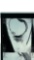 Nikki Sixx of Motley Crue Knee X-Ray