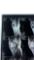 Nikki Sixx of Motley Crue Right Knee X-Ray