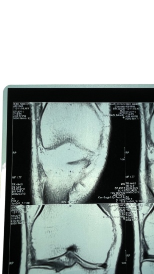 Nikki Sixx of Motley Crue Right Knee and Right Shoulder X-Ray
