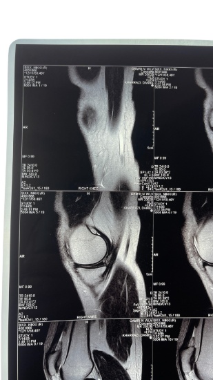 Nikki Sixx of Motley Crue Right Shoulder X-Ray