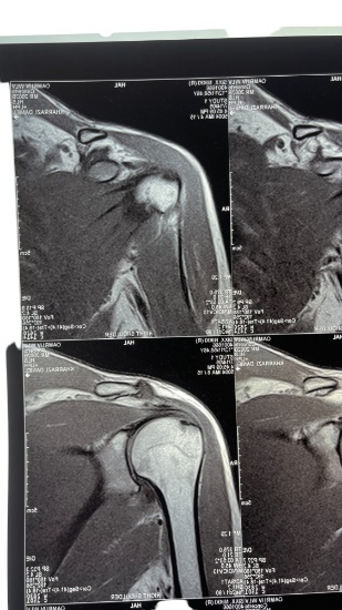 Nikki Sixx of Motley Crue Right Knee and Right Shoulder X-Ray