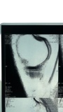 Nikki Sixx of Motley Crue Knee X-Ray