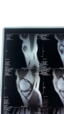 Nikki Sixx of Motley Crue Right Knee X-Ray
