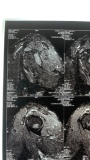 Nikki Sixx of Motley Crue Right Shoulder X-Ray