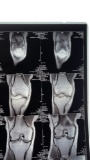 Nikki Sixx of Motley Crue Right Knee X-Ray