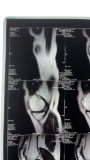 Nikki Sixx of Motley Crue Right Shoulder X-Ray