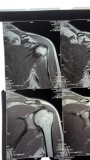 Nikki Sixx of Motley Crue Right Knee and Right Shoulder X-Ray